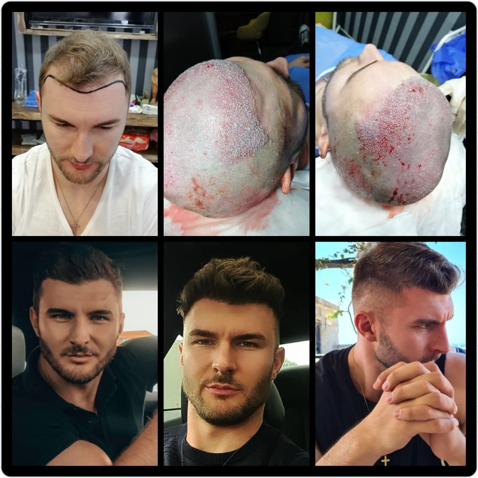 Hair transplant before and after — case 58